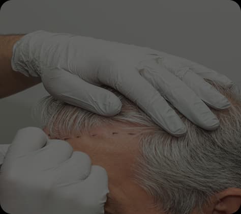 Corrective Hair Transplant