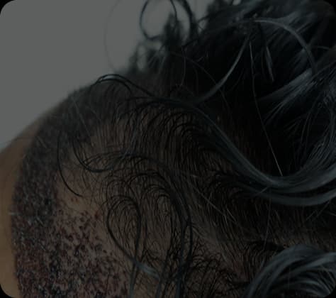 Unshaven Hair Transplant