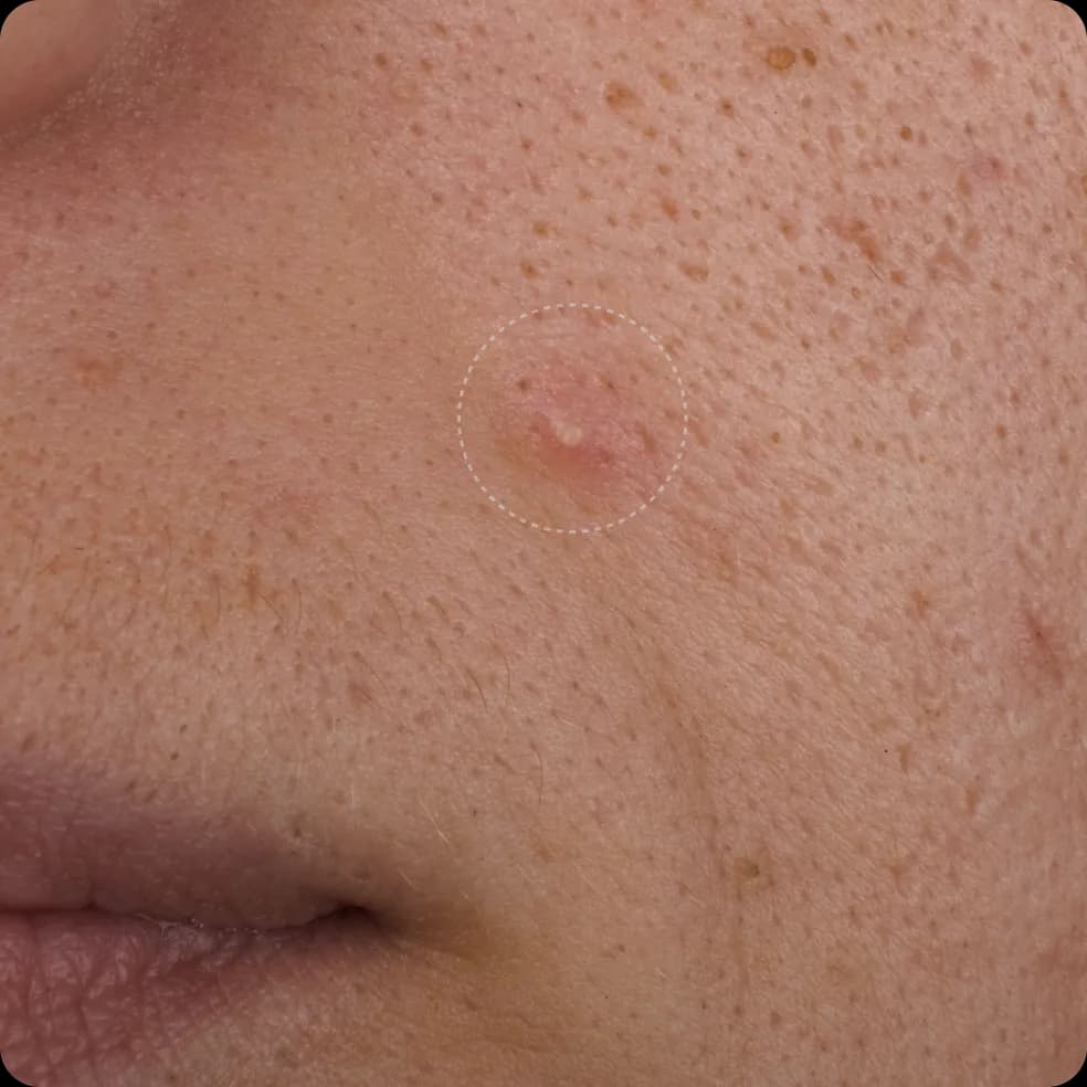 Close-up of acne-prone skin