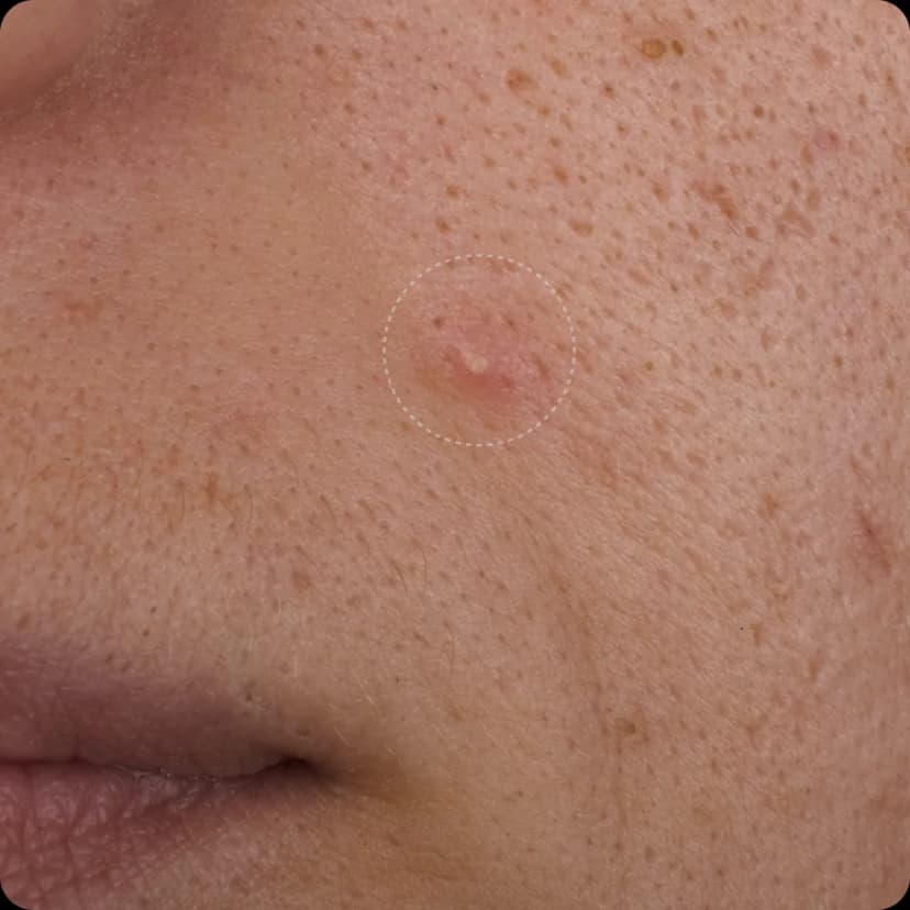 Close-up of acne-prone skin