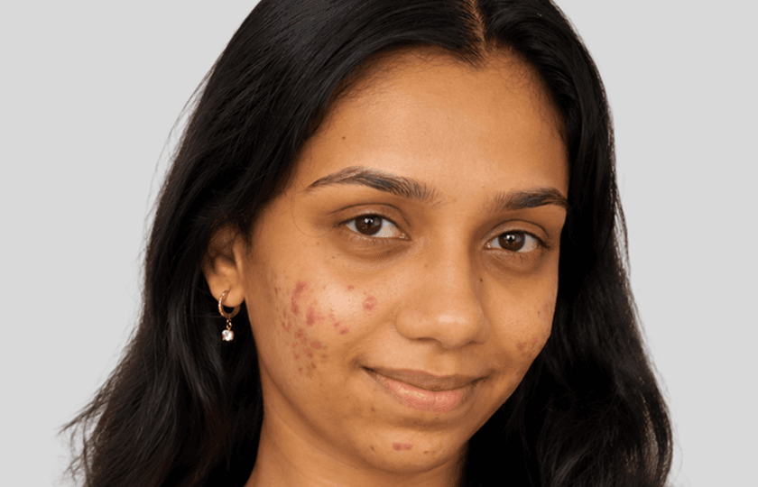 Shravani before Chemical Peels treatment