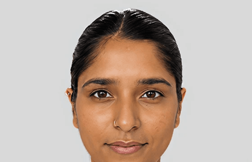 Shweta after Dermapen treatment