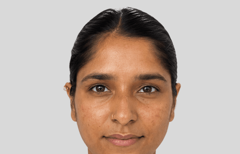 Shweta before Dermapen treatment