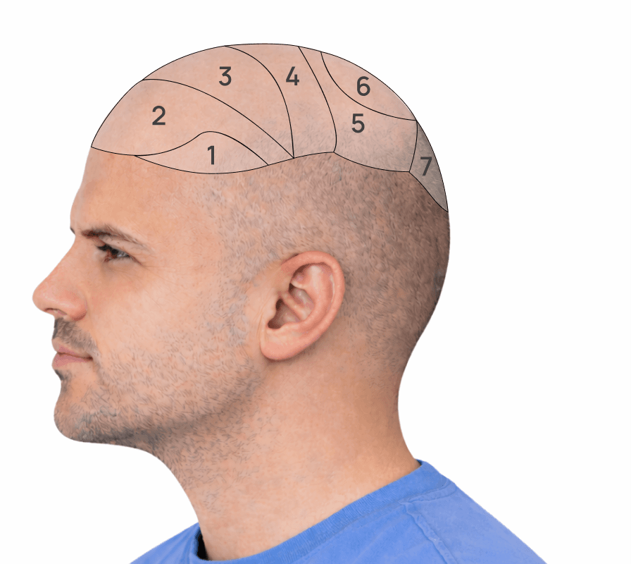 Side view of head with zones