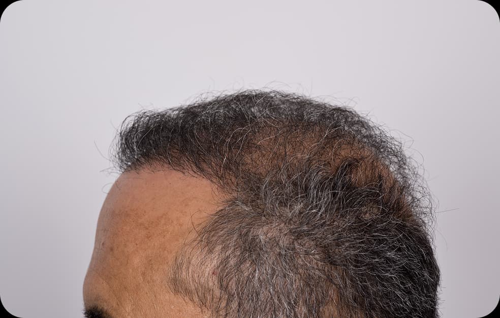 Corrective Hair Transplant: Complete Guide to Revision Hair Surgery