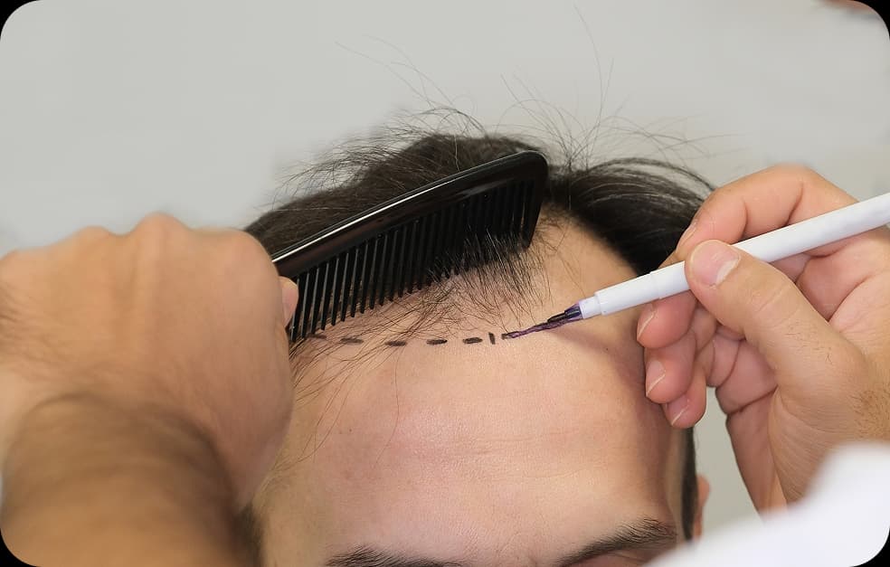 Hairline Correction: Complete Guide to Hair Restoration Refinement