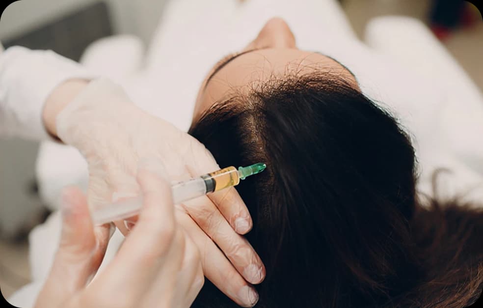 Mesotherapy for Hair Loss: A Deep Dive into the Science and Effectiveness