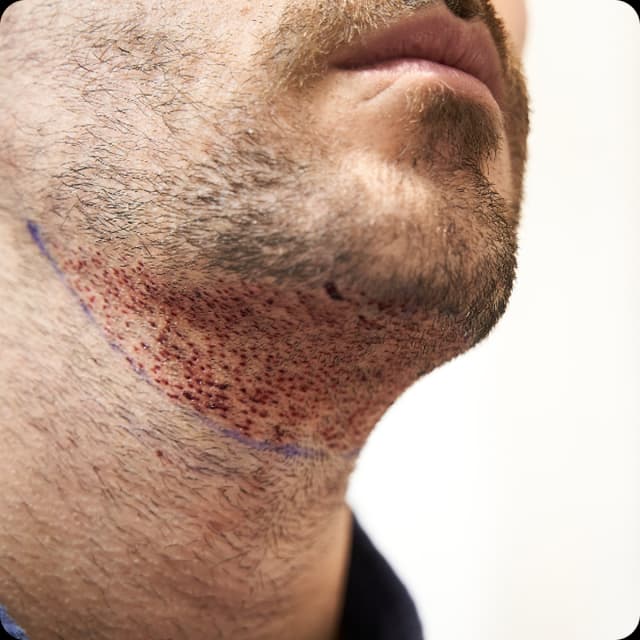 Body Hair Transplant (BHT)