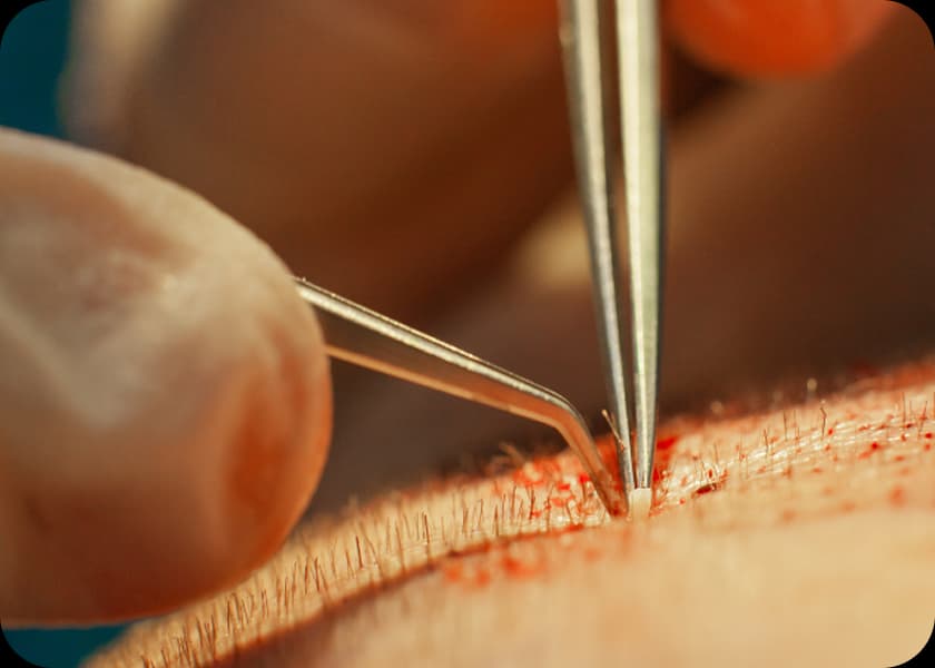 Step 4: Implantation