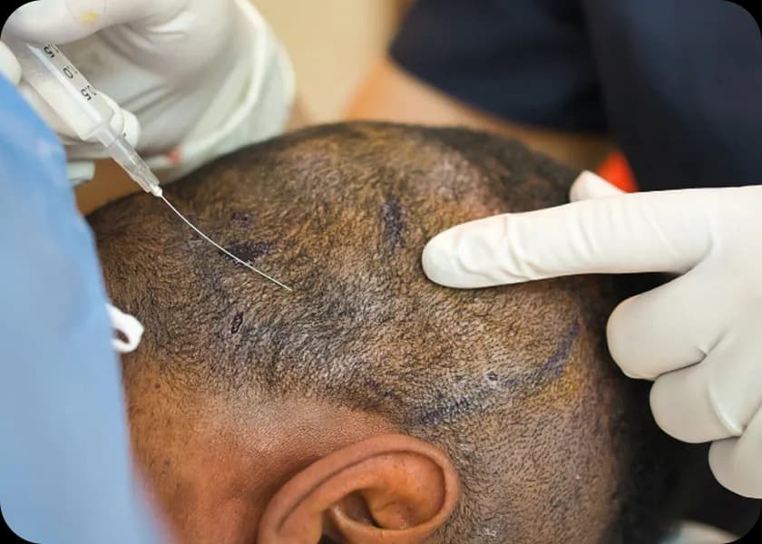 Step 1: Local Anesthesia