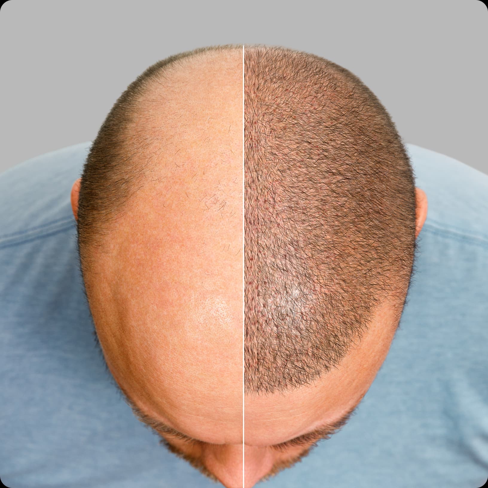 Hair Transplant Banner