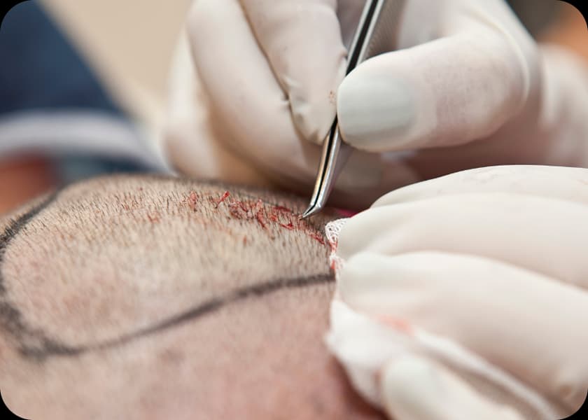 Step 2: Selective Graft Removal (if needed)