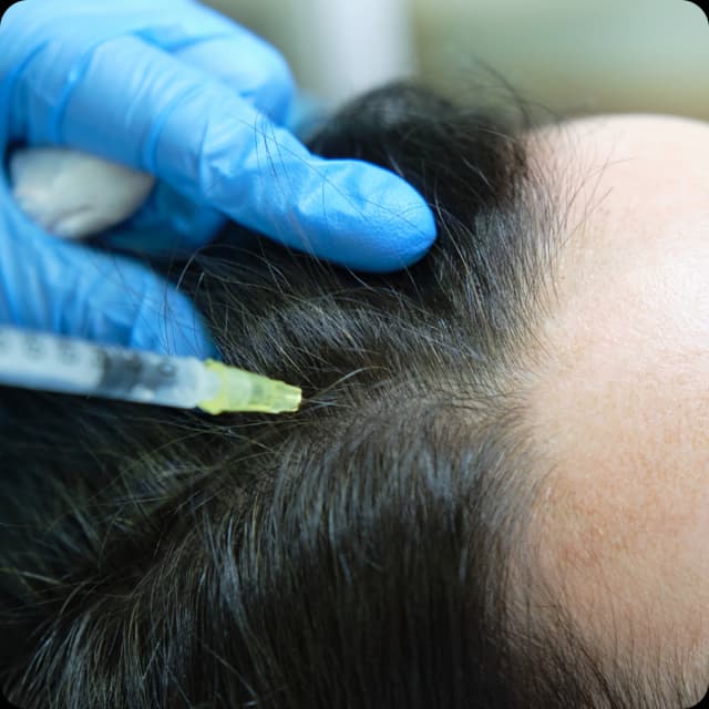 Mesotherapy for Hair Regrowth