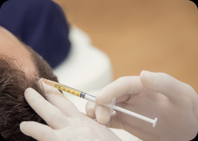 Step 4: Injection into the Scalp