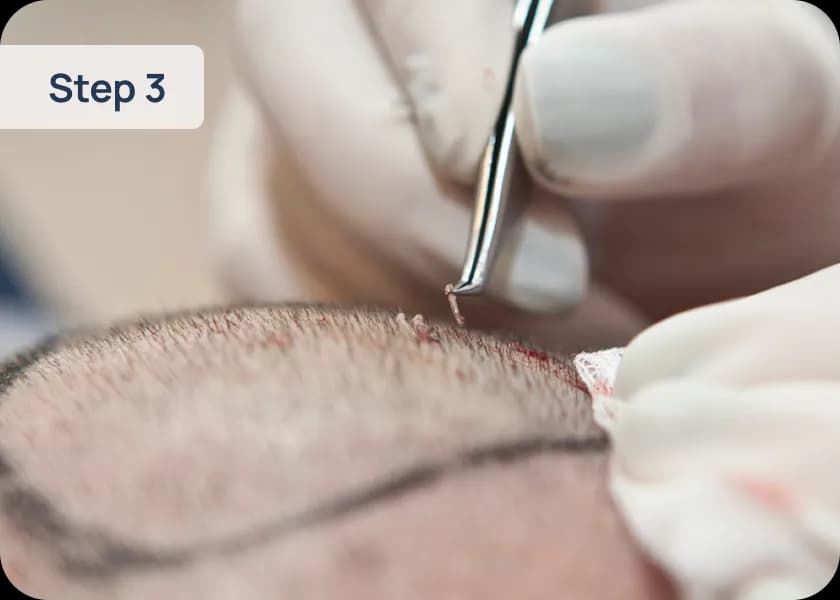 Step 3: Simultaneous Extraction & Implantation