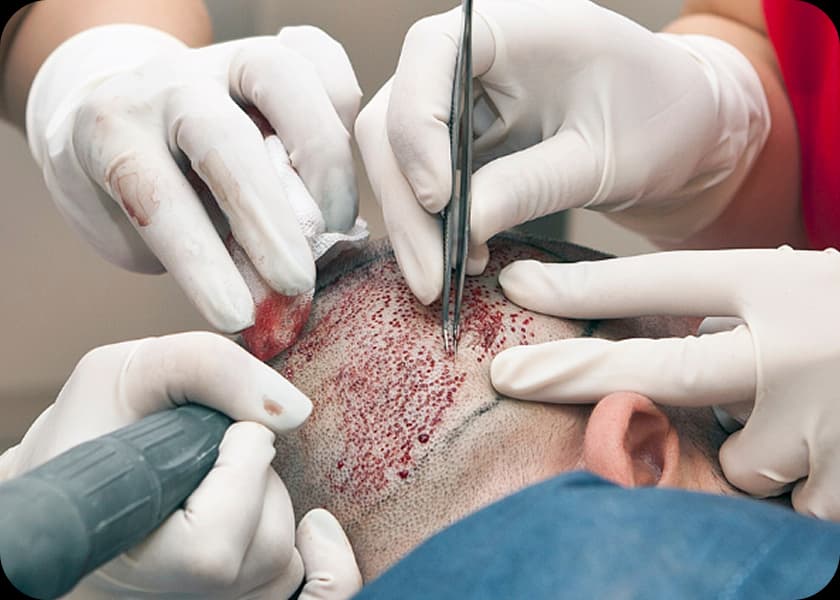 Step 3: Graft Extraction