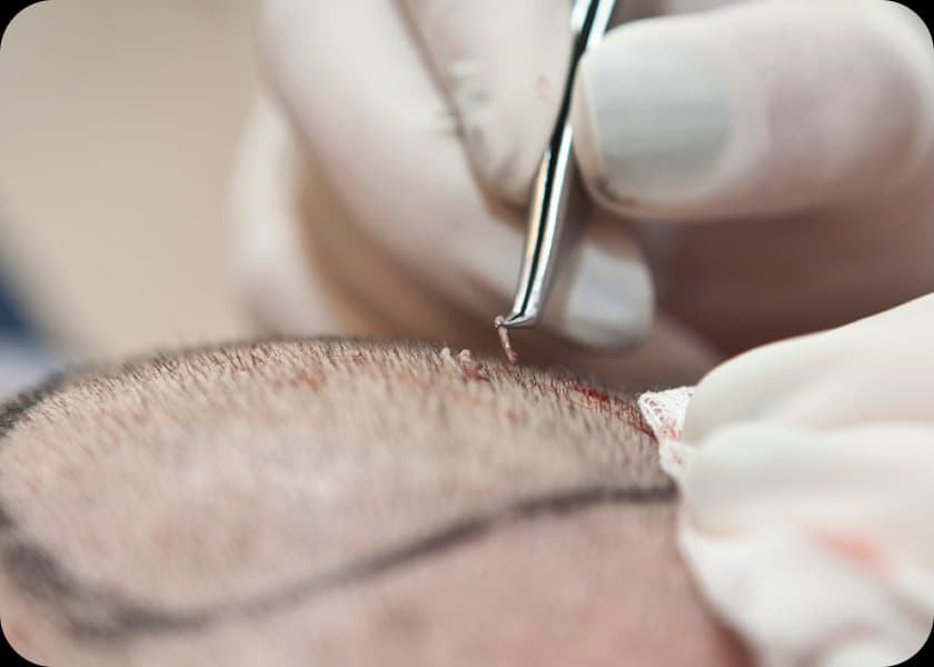 Step 4: Implantation