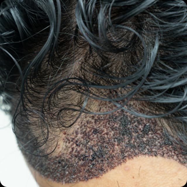 Unshaven Hair Transplant