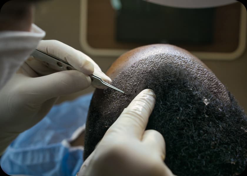 Step 4: Graft Implantation