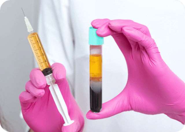 GFC Therapy (Growth Factor Concentrate Therapy)