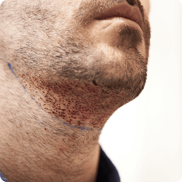 Body Hair Transplant (BHT)