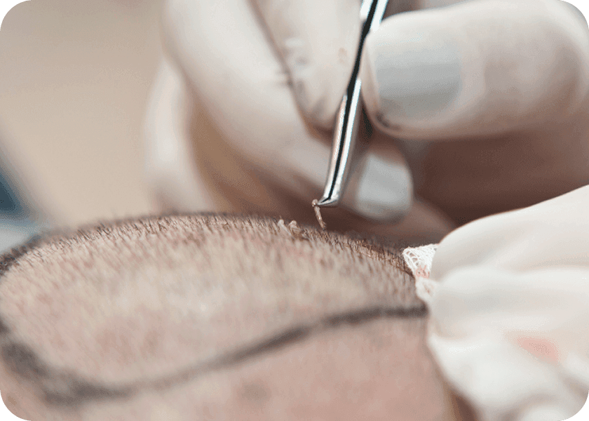 Step 2: Selective Graft Removal (if needed)