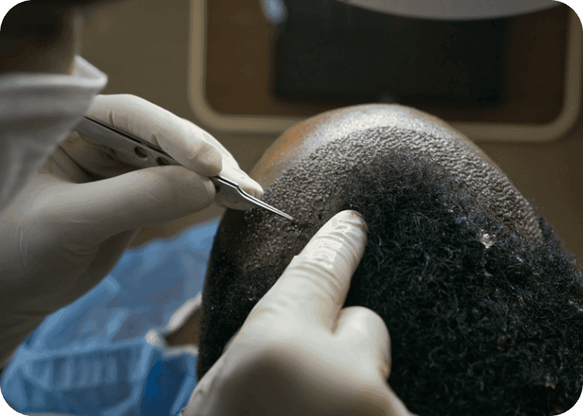Step 4: Implantation