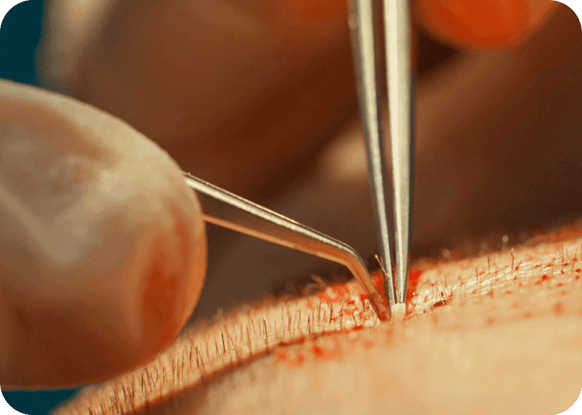 Step 4: Implantation
