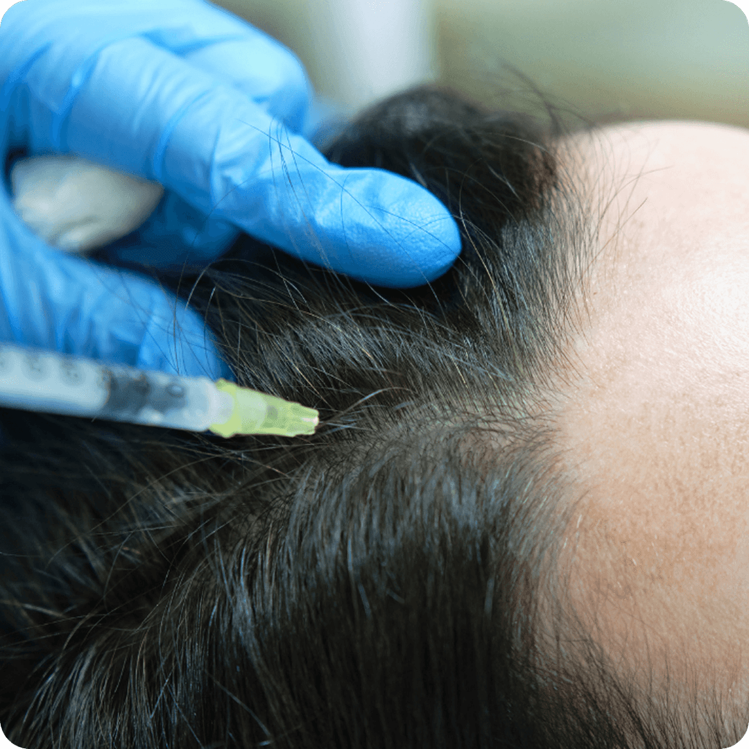 Mesotherapy for Hair Loss