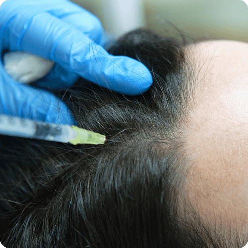Mesotherapy for Hair Loss: A Deep Dive into the Science and Effectiveness