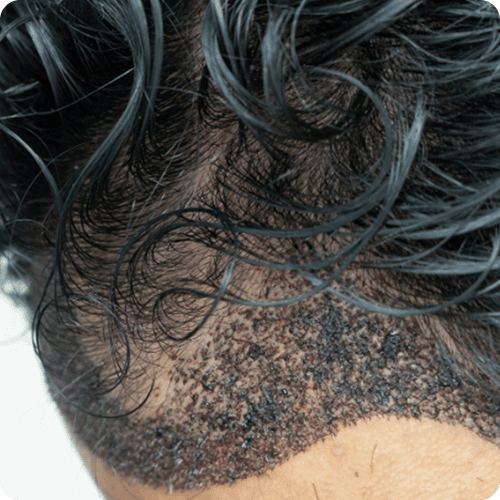 Guide to Unshaven Hair Transplant