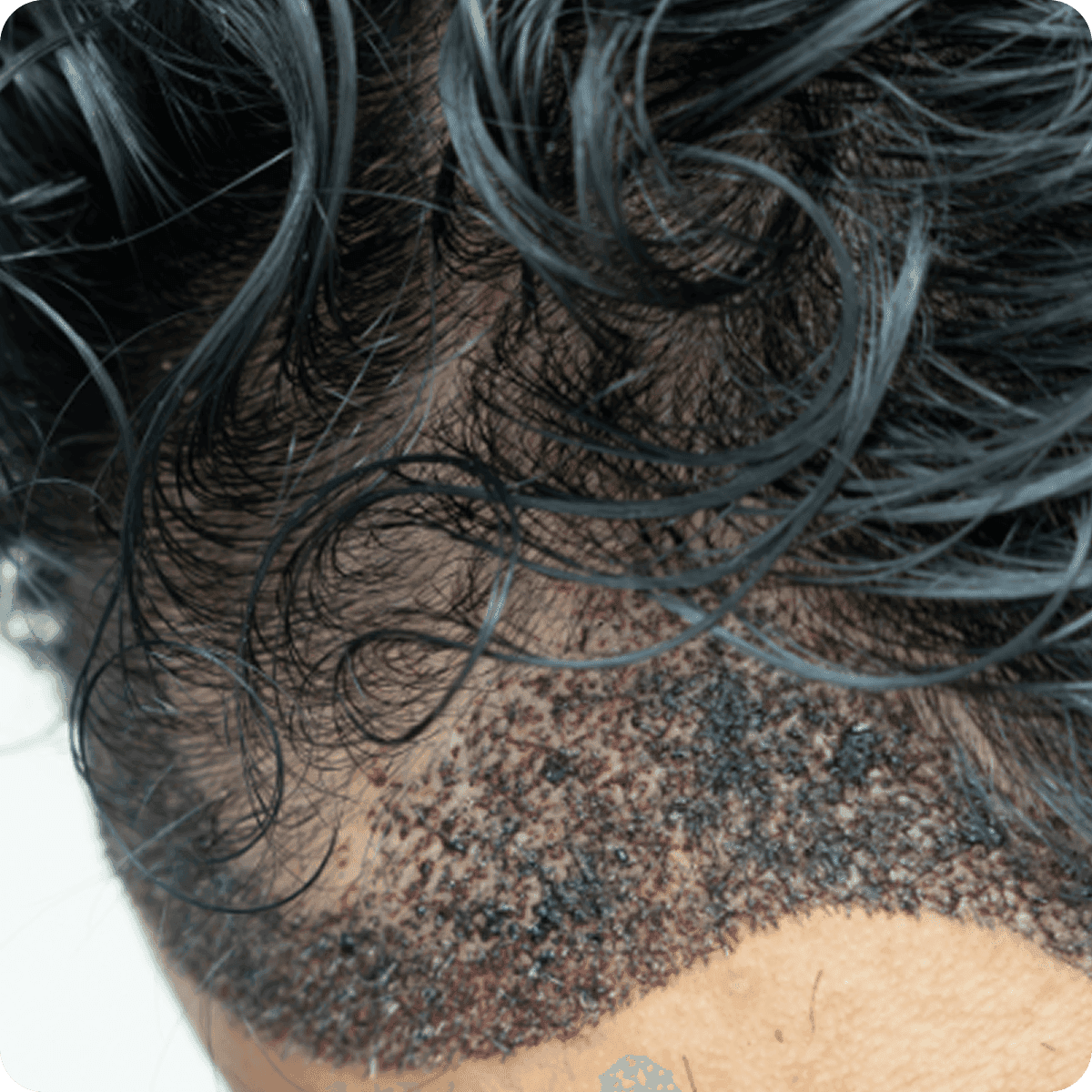 Unshaven hair transplant procedure showing discreet treatment