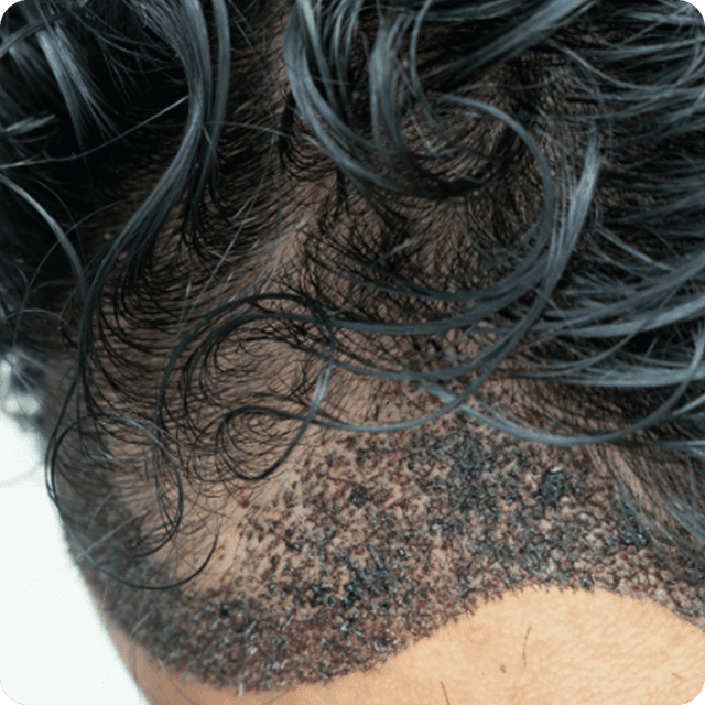 Unshaven Hair Transplant