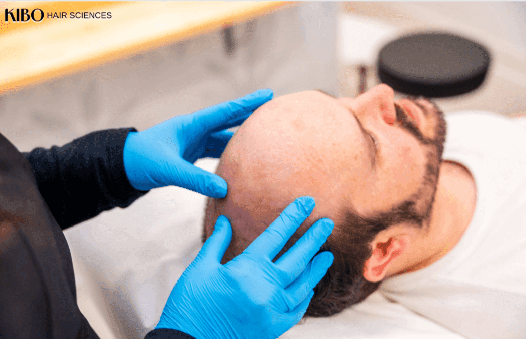 Advanced baldness treatment using body hair transplant for extended coverage