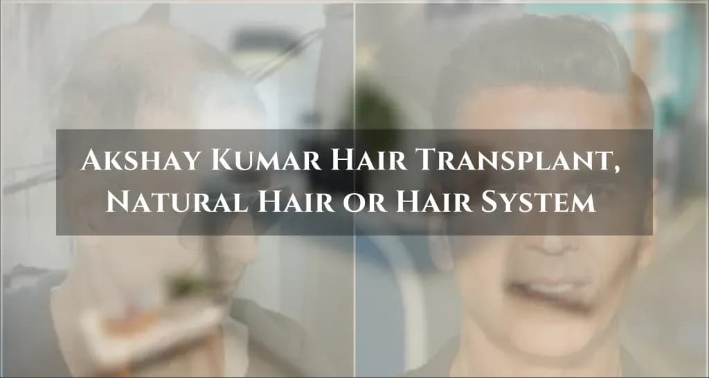 Akshay Kumar hair transplant analysis and results