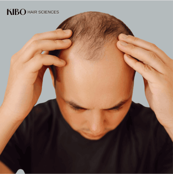 Body hair transplant for advanced baldness showing extended donor usage
