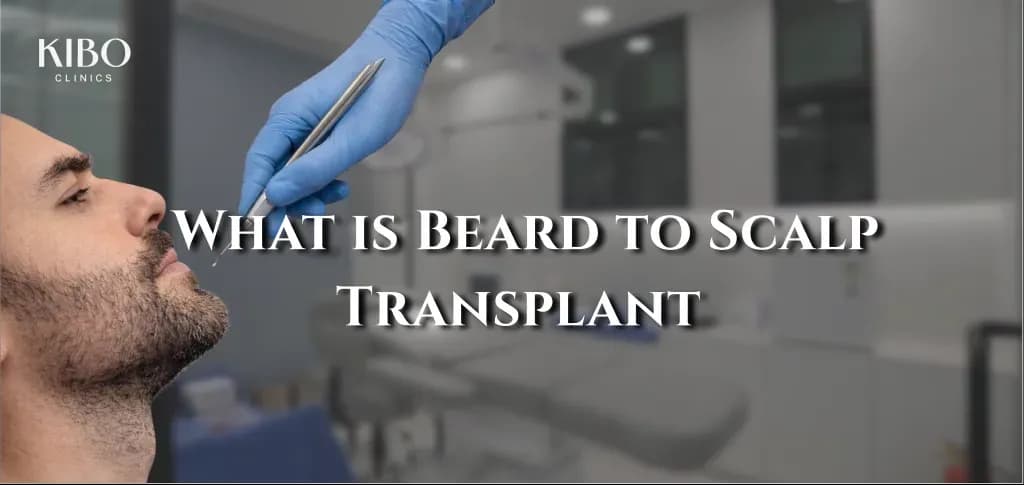 Beard to scalp hair transplant