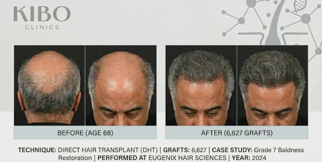 Boney Kapoor before and after hair transplant showing Grade 7 baldness restoration using Direct Hair Transplant technique with 6,627 grafts at age 68 at Eugenix Hair Sciences in 2024