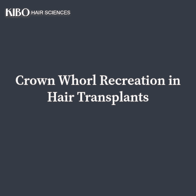 flat lay navy blue background with text "Crown Whorl Recreation in Hair Transplants" centred and in middle and on top left corner there is Kibo clinics logo