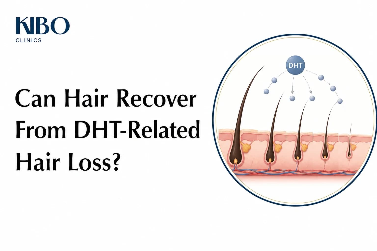 Kibo Clinics featured image showing DHT-related hair loss and follicle miniaturisation