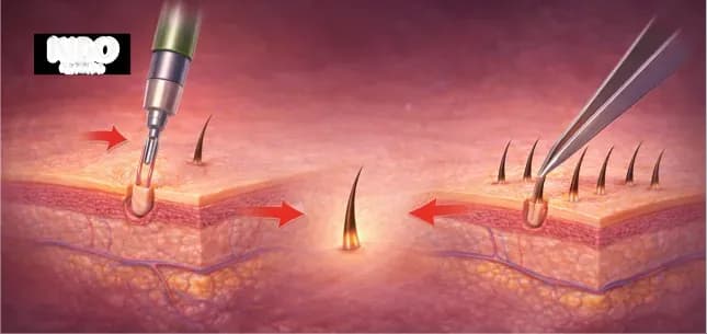 FUE hair transplant procedure showing extraction and implantation