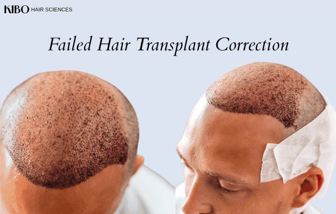 FUE revision surgery correcting previous failed transplant results