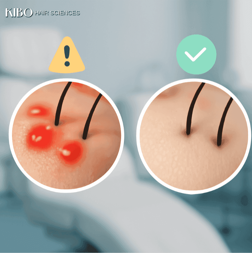 folliculitis after hair transplant