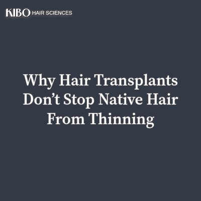 Why Hair Transplants Don’t Stop Native Hair From Thinning