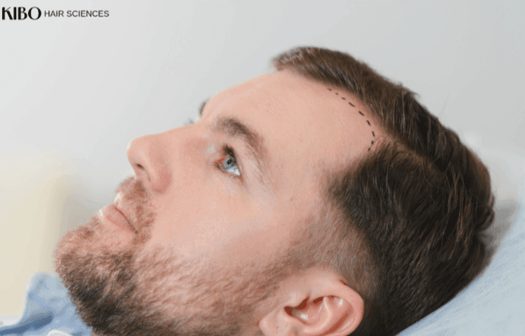 Fixing patchy hair transplant results with improved density