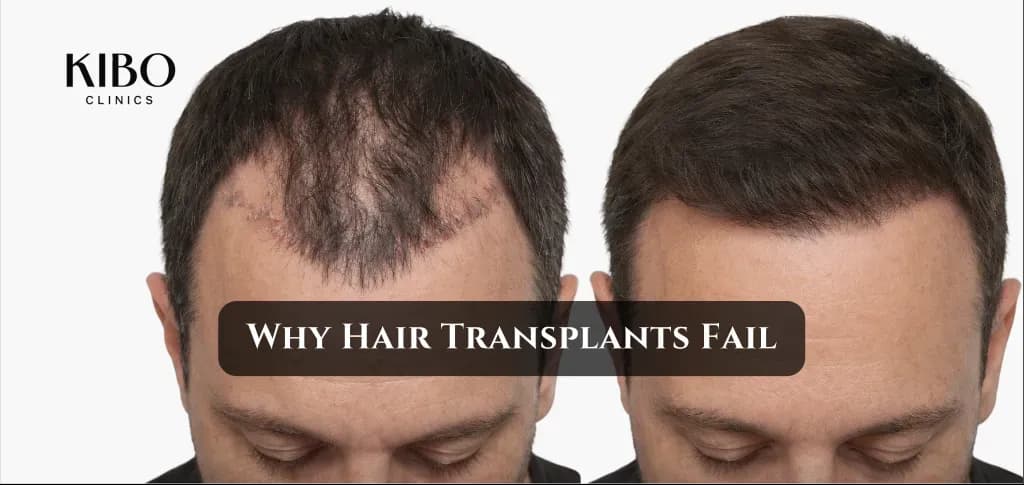 hair transplant failed