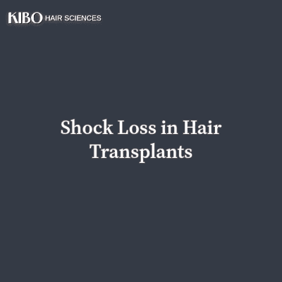 flat lay navy blue background with text "Shock Loss in Hair Transplants" centred and in middle and on top left corner there is Kibo clinics logo