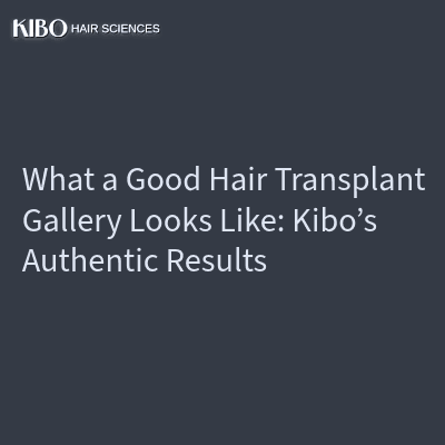 What a Good Hair Transplant Gallery Looks Like: Kibo’s Authentic Results