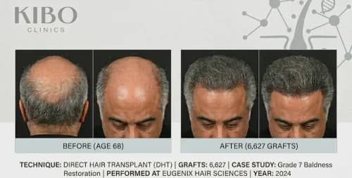 Boney Kapoor Hair Transplant: Bollywood Producer's Inspiring Transformation at 68