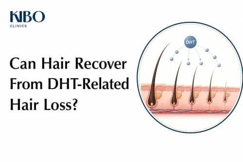 Can Hair Recover From DHT-Related Hair Loss?